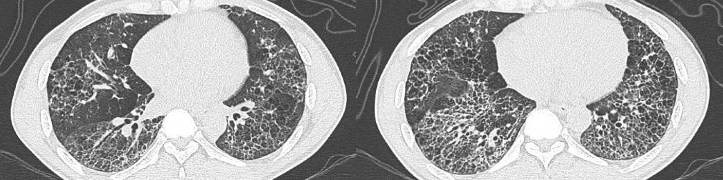 HRCT, case presentation